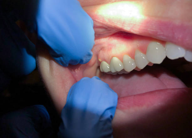 Best Emergency Denture Repair in USA